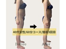 ネオボディ(Neo Body)/施術期間1ヶ月