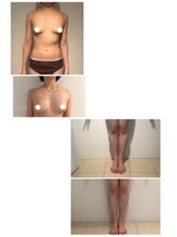 メゾン アンジュ(Maison Ange)/【痩身】高周波超音波・症例