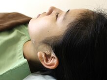 いなほ はりきゅう整骨院 東新宿/美容鍼施術/手順12