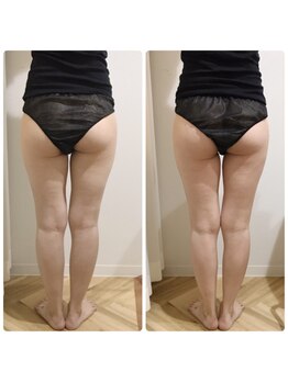 リボディ プラチナ(Rebody platinum)/脂肪冷却×半身ケア