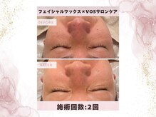 ウェリナポノビューティサロン(welina pono beauty salon)/《小顔/毛穴/脱毛》