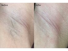 ルアナ(Luana)/【Before/after】シュガーリング