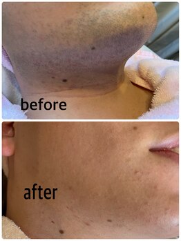 ビーティベーシック(B.t.Basic)/青ヒゲもこのとおり！