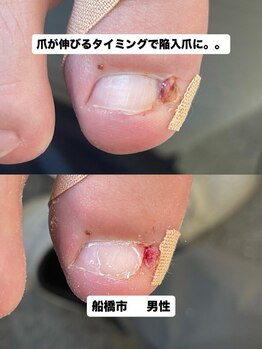 巻き爪じゅん 千葉駅前店/爪が伸びるたび陥入爪で悩に。。