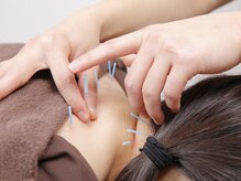 初めての方も！当院の鍼を体験してみてください。