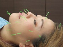 吉祥寺みやま鍼灸院/鍼施術風景