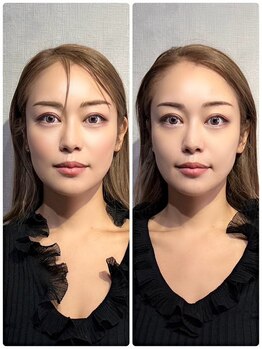 メディカルエース(MedicalAce)/【最強引き上げ】ハイサーマ