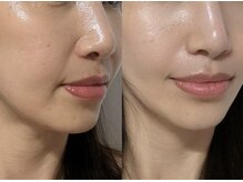 エステサロン 美飾り イオンモール木更津店/before⇒after/リフトケア