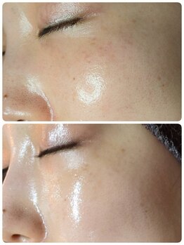 ウララ(ulala)/ララピール4回目