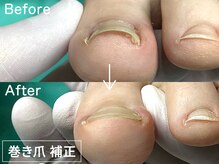 ディオフット(DIO FOOT)/【巻き爪補正】一度の施術で改善