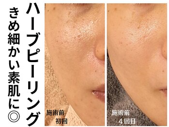 エリン(ERIN)/毛穴徹底洗浄×ハーブピーリング