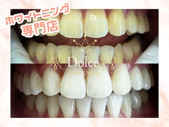 ドルチェ(Dolce)/ビフォーアフター