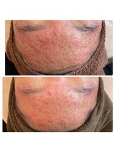 サンテボーテ(Sante Beaute)/ハーブピーリング1回目