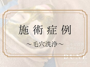 デューン 蕨店(Dune)/施術症例～毛穴洗浄～