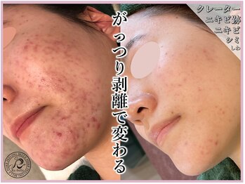 アッシュ 梅田(H)の写真/梅田で剥離ありハーブピーリング！輝く花嫁姿を目指す特別なケアを体験◎