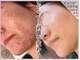 アッシュ 梅田(H)の写真/梅田で剥離ありハーブピーリング！輝く花嫁姿を目指す特別なケアを体験◎