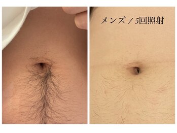 エクラ(eclat)/メンズへそ脱毛