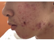 オアシスラグーン(OASIS LAGOON)/ニキビケア（症例２：before）