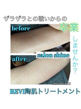 サロンシャイン(Salon Shine)/二の腕のハーブピーリング１回