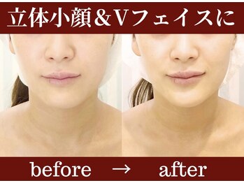 ガーデン(Garden)/【小顔】リフトアップコース