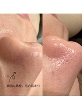 アムリリー 南草津店(AMRILY)/毛穴洗浄ハイドラフェイシャル