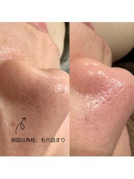 アムリリー 南草津店(AMRILY)/毛穴洗浄ハイドラフェイシャル