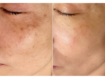 オリエンタルビューティー(ORIENTAL BEAUTY)/光フェイシャル