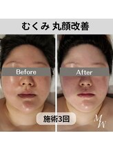 ミピマム/世界大会受賞の小顔コルギ