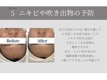 サラ 恵比寿店(SARA)/５フォトRF顔脱毛のメリット