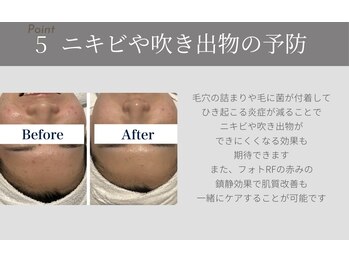 サラ 恵比寿店(SARA)/５フォトRF顔脱毛のメリット