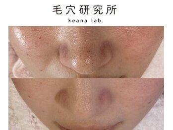 毛穴研究所の写真/【都度払いOK】敏感になりがちな大人肌に◇黒ずみ・詰まり・開き毛穴をやさしく整える毛穴ケア
