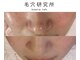 毛穴研究所の写真/【都度払いOK】敏感になりがちな大人肌に◇黒ずみ・詰まり・開き毛穴をやさしく整える毛穴ケア