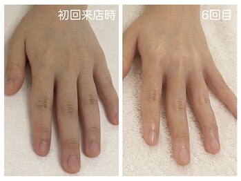 キレイテ 上野店/30代/7回目【ハンドケア稲荷町】