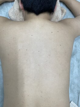 ナノハナ/鹿沼市の全身脱毛のナノハナ