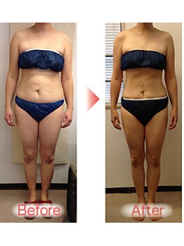 ピーキュア/3カ月ビフォーアフター