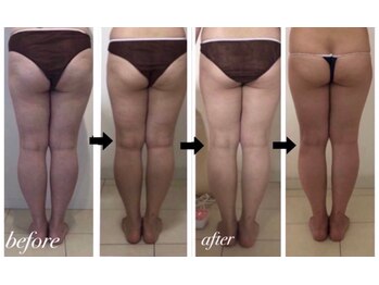 美人バスト 札幌店/ダイエット◇症例◇バストアップ