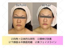 アンジェリカ(Angelica)/背中高周波で効果UP★