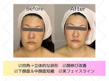 アンジェリカ(Angelica)/背中高周波で効果UP★