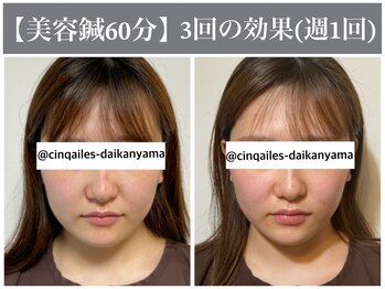 サンクエール 代官山鍼灸院(CINQ AILES)/美容鍼灸　むくみ・たるみ改善