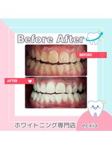 エクシアホワイトニング 札幌中島公園店/BeforeAfter［ホワイトニング］ 