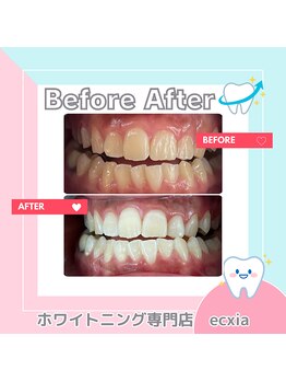 エクシアホワイトニング 札幌中島公園店/BeforeAfter［ホワイトニング］ 