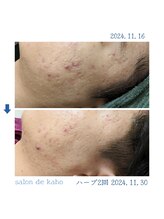 サロン ド 花歩 松山本店/業界最速の肌変！ニキビ毛穴改善