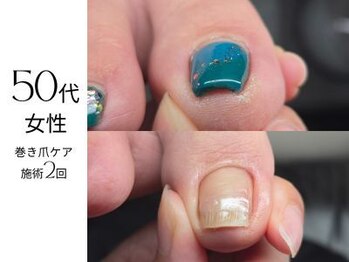 フットケア クラッシー(footcare classy)/巻き爪/BSSPANGE/nailtrim