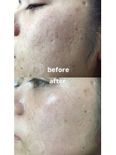 セレネ(SELENE)/毛穴、毛穴開き、凹凸