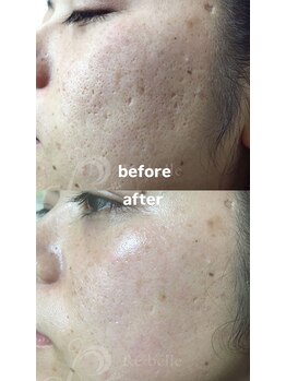 セレネ(SELENE)/毛穴、毛穴開き、凹凸