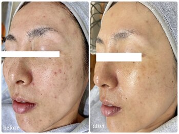 ブロッサム(Blossom)/ホワイトスノーピール5回目