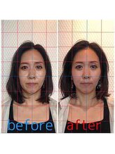 ルディア 堂島店(ledia)/西梅田美容鍼1回での変化