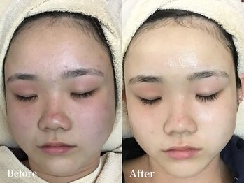 ラウレア 松山店(LAULEA)/ハーブピーリングbefore/after