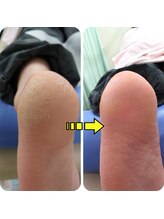 どうはく堂 西勝山接骨院/踵のガサガサ角質