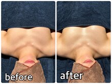 リルマコ/バスト症例写真